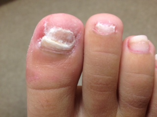 White Spots On Toenails Fungus